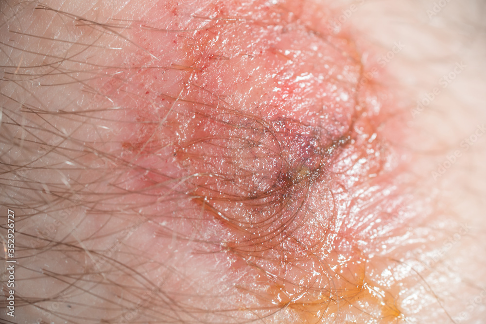 wound on the skin. macro wound on the skin. macro