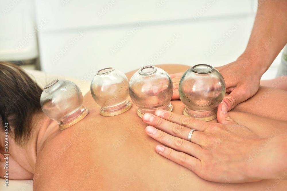 Young female physiotherapist applying glass suction banks on back of her patient, during cupping therapy, closeup detail Young female physiotherapist applying glass suction banks on back of her patient, during cupping therapy, closeup detail