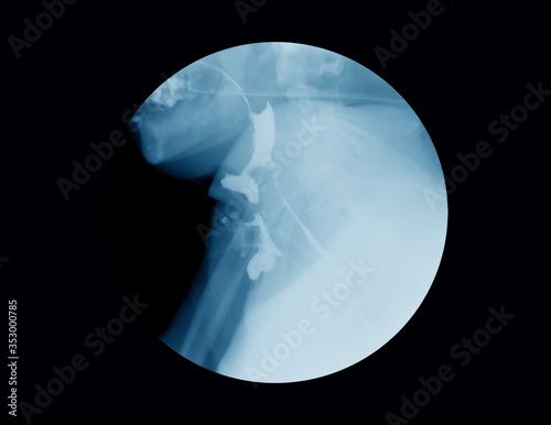 X-ray image of Barium meal examination ( or Barium swallow, Upper gastrointestinal study, contrast radiography of the upper gastrointestinal tract and barium meal)