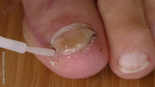 Close up of treatment of fungal infected toe nail with tincture.