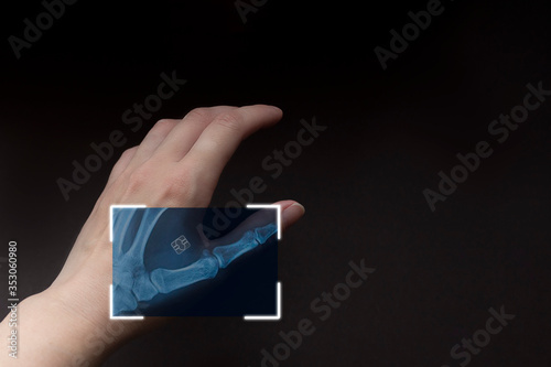 Microchip under the skin in an x-ray. People Chipping Concept. Spying on people. Future chipping technologies.