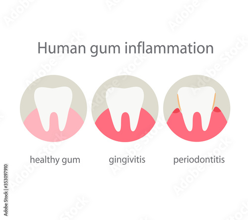 Human gum inflammation.Information about dental heath. photo