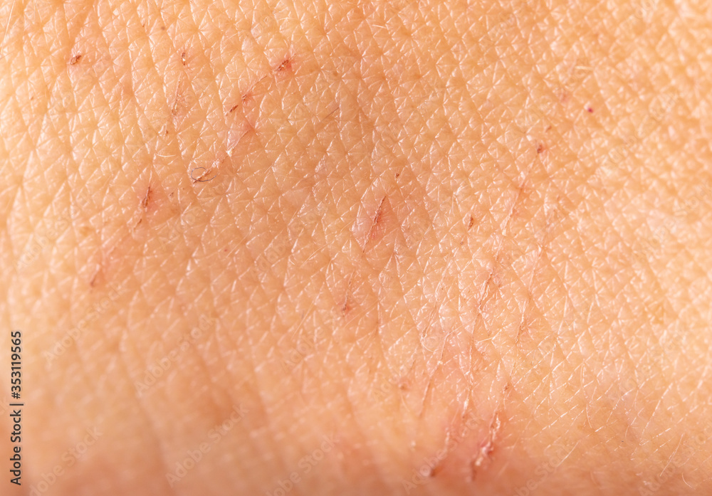 Fototapeta premium A wound on the skin of a person as a background.