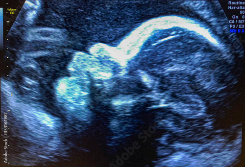 Baby's face ultrasound, 30 weeks pregnancy