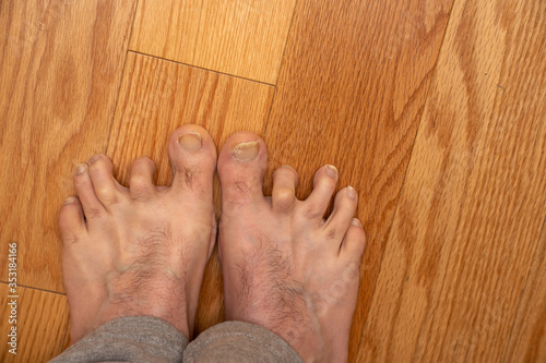 Mens hammer toes with dislocated joints before surgery  photo