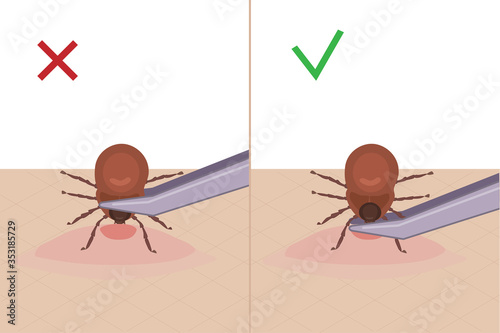 A tick bites a person. How to remove a tick from the skin. A parasite carrying a disease. Vector illustration