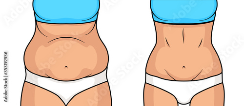 Female belly fat loss plastic surgery. Abdomen fatty girl abs lose before and after cellulite