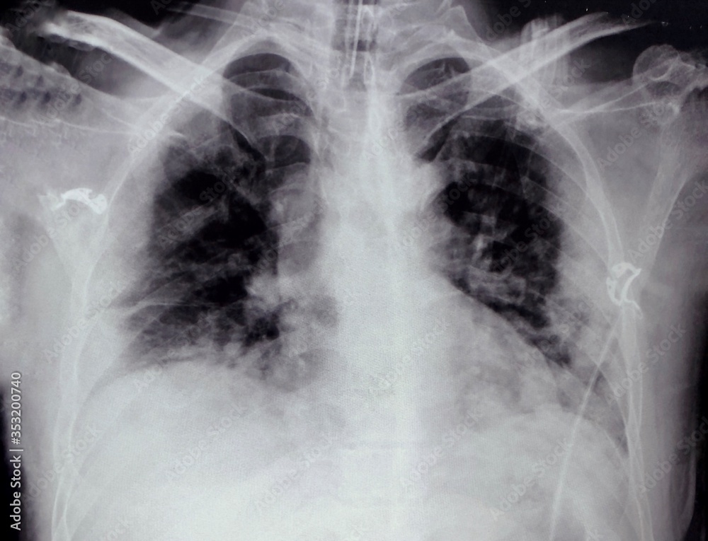 chest x ray chest x ray