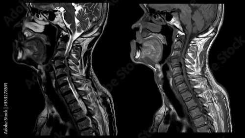 MRI OF CERVICAL SPINE IMPRESSION: Moderate to severe posterior central disc protrusion of C3/4 to C5/6  intervertebral discs with 2.0 cm in length small posterior subligamentous fluid.Medical footage.