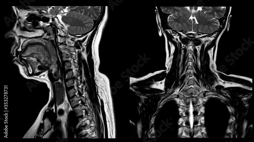 MRI C-Spine There is hypersignal intensity lesion in the spinal cord at C4 to C6 levels,too soft and blurry selective focus when views full solution.Medical footage.