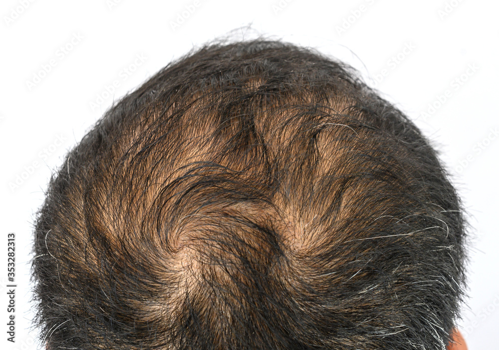 Top view of men's head with thin hair and a hair whorls. Hair whorl is a  patch of hair growing in a circular direction around a visible center  point. Stock Photo |