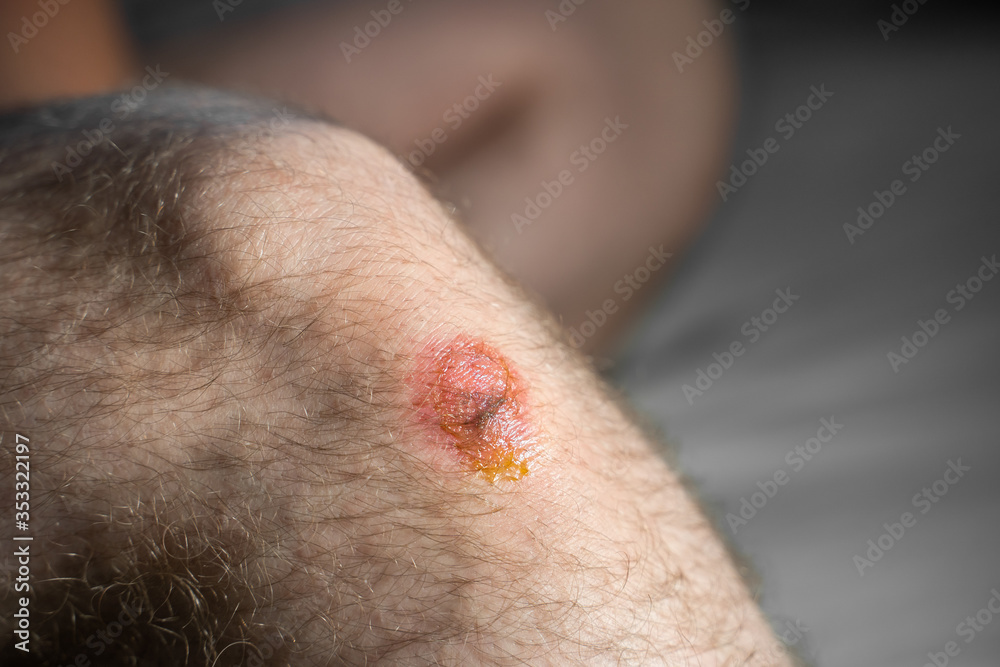 Scar of strong man on leg from closeup view Scar of strong man on leg from closeup view