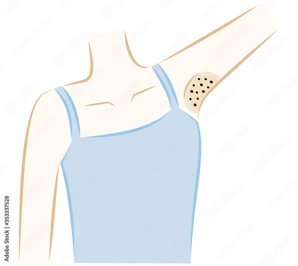 女性 脇 黒ずみ 色素沈着 埋没毛 Armpit Blackhead Hair Loss Stock Vector Adobe Stock