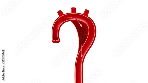 Aortic dissection. 2D animation of the human aorta