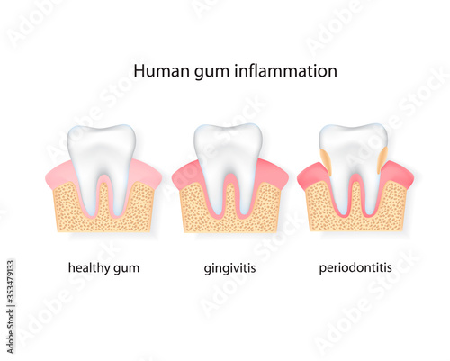 Human gum inflammation