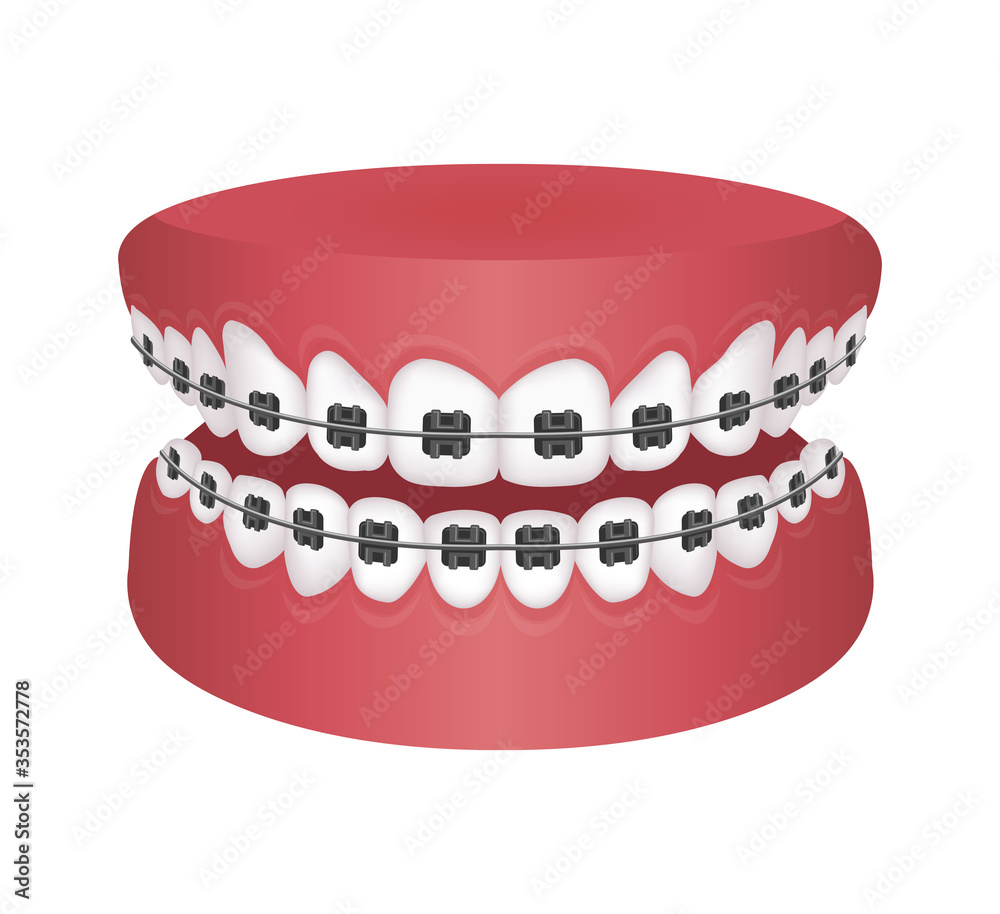 Dental braces flat vector illustration / no text Dental braces flat vector illustration / no text