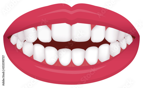 Teeth trouble ( bite type / crooked teeth ) vector illustration /Open bite