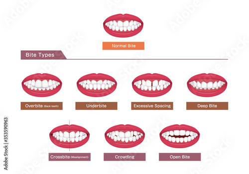 Teeth trouble ( bite type / crooked teeth ) vector illustration set photo