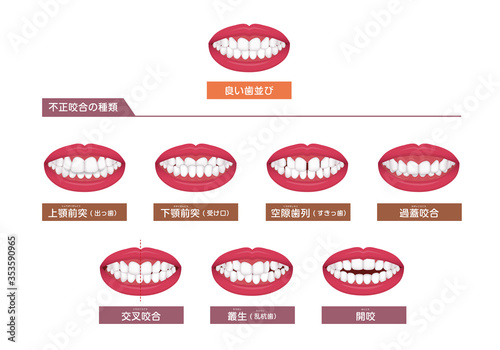 歯並び・歯列・不正咬合の種類 ベクターイラストセット photo