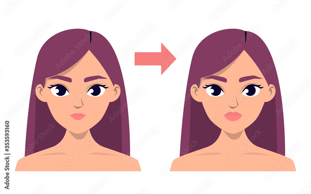 Before and after lip injection vector isolated Before and after lip injection vector isolated