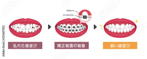 歯列矯正・歯の矯正のプロセス　ベクターイラスト