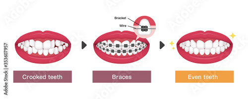 Dental braces process vector illustration