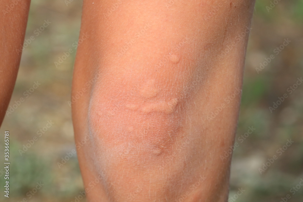 The child's knee burned with nettle grass. Type of burn Stock Photo