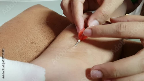 Piercing the arm to donate blood