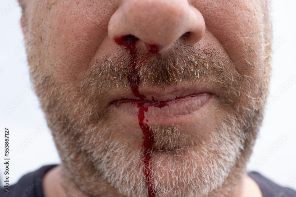 Obraz premium nosebleed , A man is bleeding from his nose