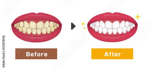 Teeth whitening vector illustration / before and after
