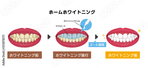 歯のホワイトニング（ホームホワイトニング）のながれ　ベクターイラスト 