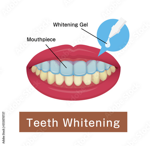 Teeth whitening at home vector illustration
