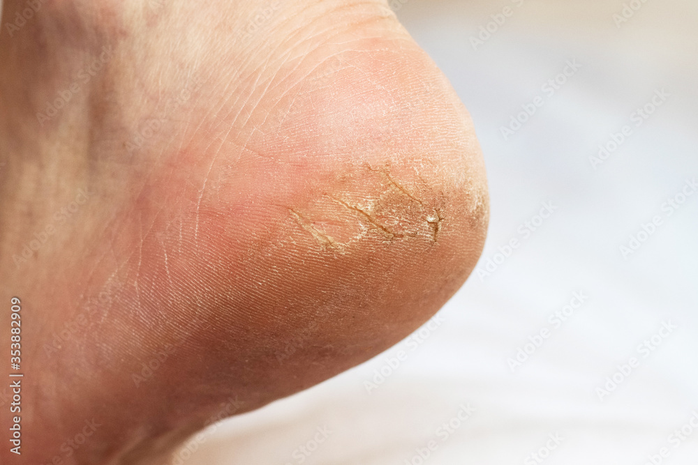 Man's leg with cracks on the heel Man's leg with cracks on the heel