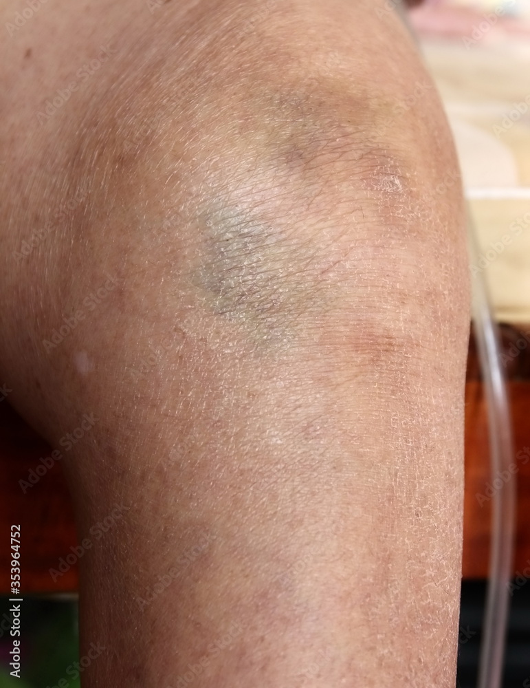 Fototapeta premium knee bone inflammation elderly woman