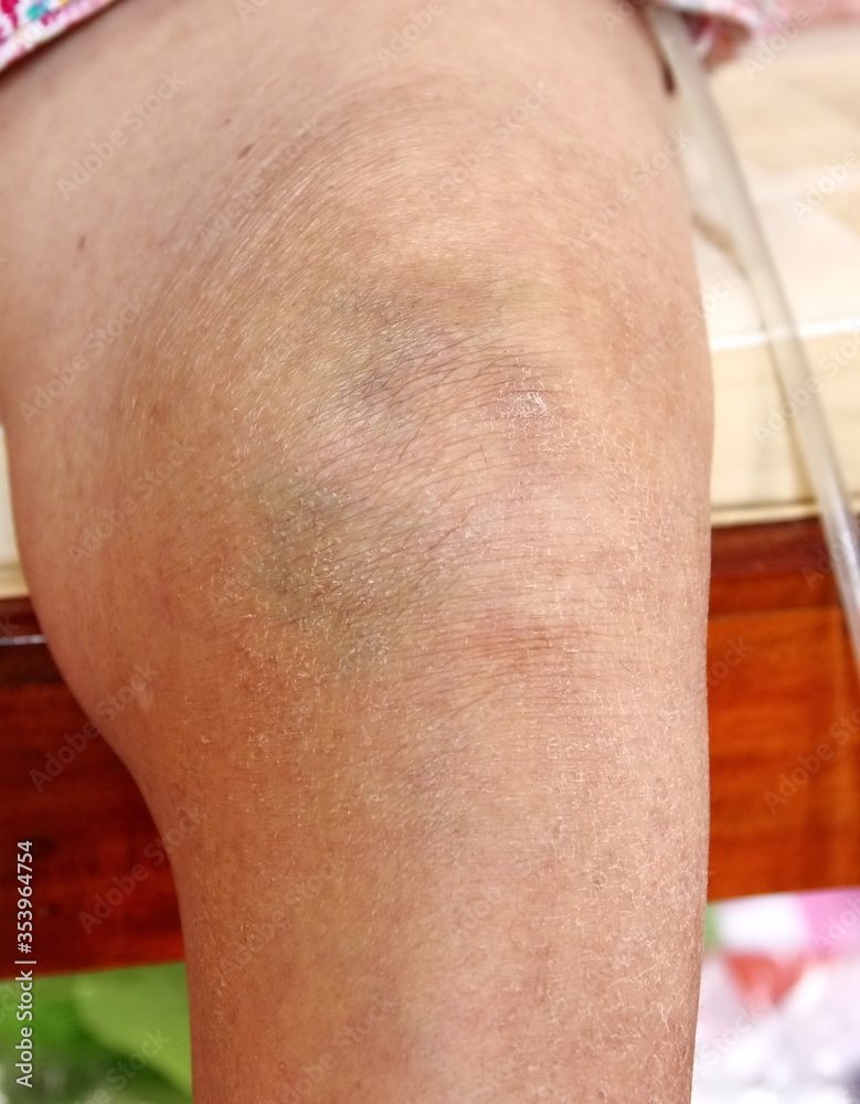 Naklejka premium knee bone inflammation elderly woman
