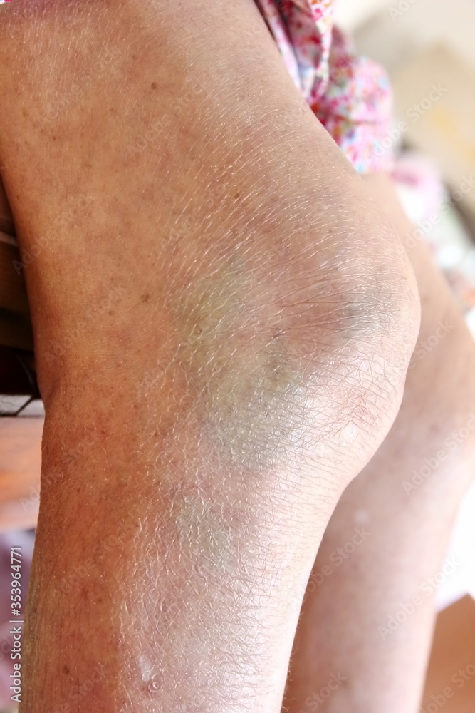 Fototapeta premium knee bone inflammation elderly woman