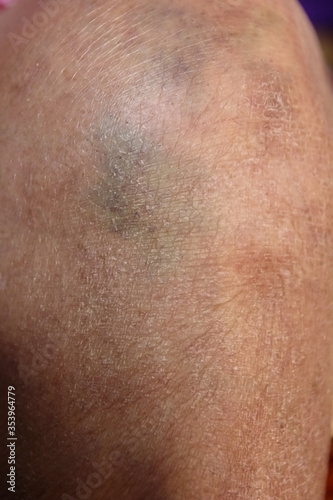 close up knee bone inflammation elderly woman