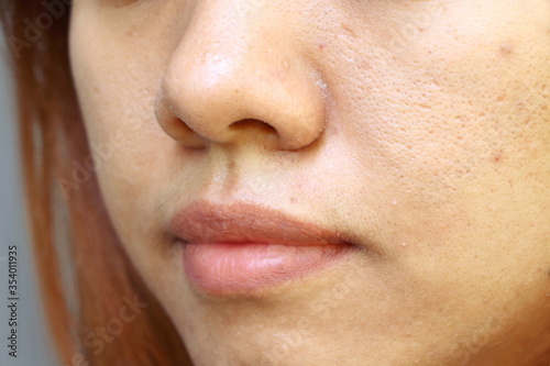 Close up oily face and have problem skin (wide pores) of Asia woman