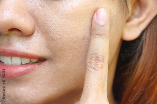 Closeup the Asian woman use fingure applying cosmetic liquid foundation on her cheek skin for hide acne and wide pores on face skin before makeup. Makeup by cosmetic concept.