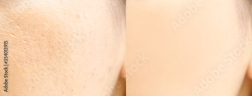 Fotografie Compare before and after (retouch photo) of close up wide large pores skin on oi