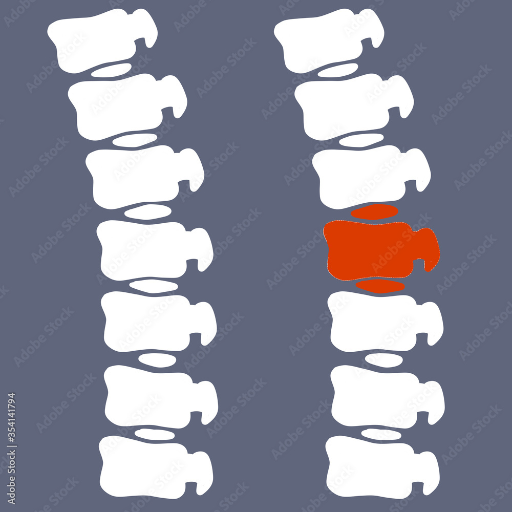 Problems with the spine. Crack in intervertebral disc. Pain and trauma. Medical care. Vertebra x-ray. Cartoon flat illustration. Poor posture on blue background. White human bones. Sore place in back Problems with the spine. Crack in intervertebral disc. Pain and trauma. Medical care. Vertebra x-ray. Cartoon flat illustration. Poor posture on blue background. White human bones. Sore place in back