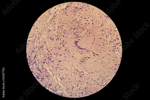 Langerhans cells (LC) are members of the dendritic cells family, residing in the basal and suprabasal layers of the epidermis and in the epithelia of the respiratory, TB granuloma.