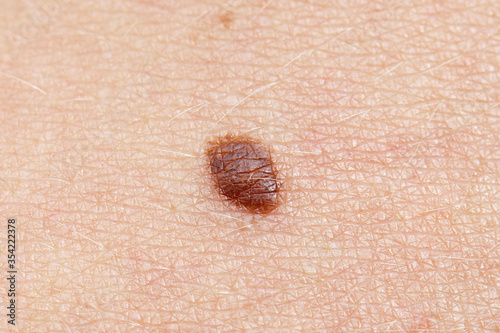 Basal Cell Carcinoma - pre-removal of a suspicious dark brown mole on the abdomen of a young woman.