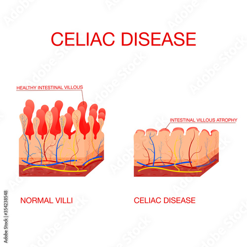 Coeliac disease or celiac disease. small bowel showing coeliac disease . normal villi and villous atrophy. Healthy and damaged villi on a white background. photo