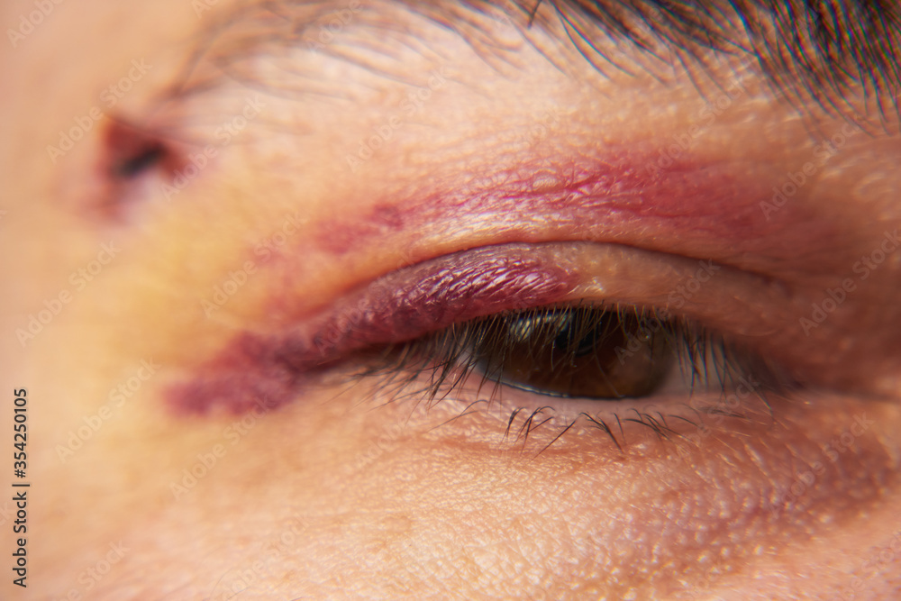 Obraz premium close view of a black eye, man's face with a hematoma
