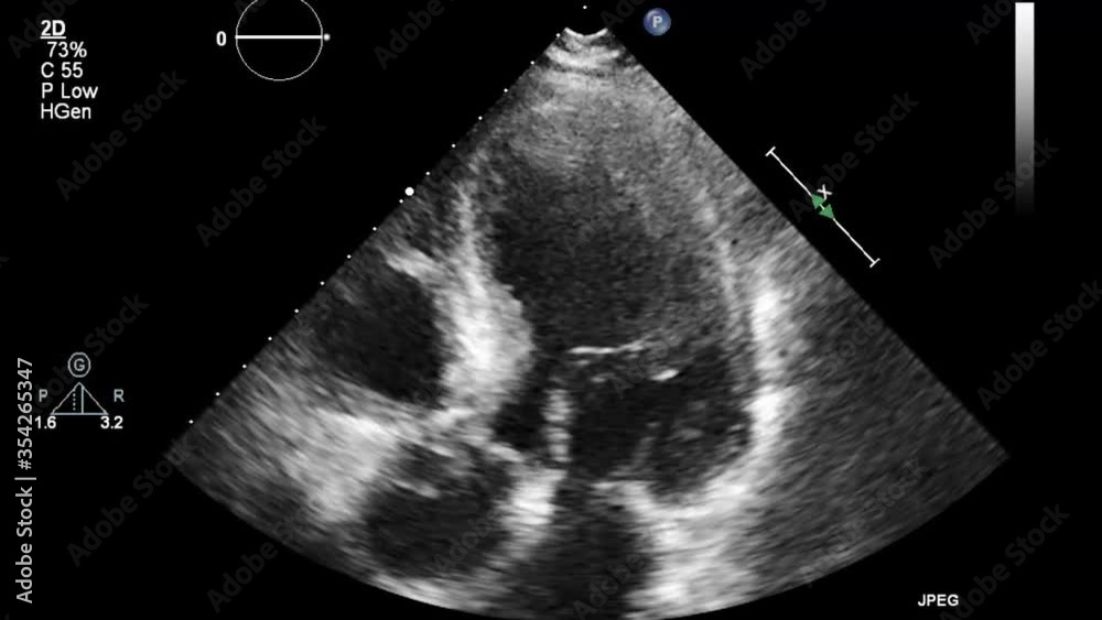 Transesophageal ultrasound video in gray-scale mode.