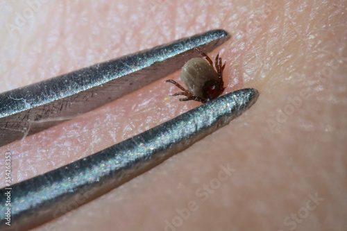 Super close up of sucking tick (Ixodes ricinus) removal with steel tweezers on human skin. Adult ticks feed on large mammals  for 6–13 days, before dropping off.         