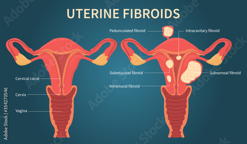 Flat vector illustration of uterine fibroids, myoma, uterine leiomyomas on dark blue background. There are cervical canal, cervix, vagina, pedunculated, intracavitary, submucosal, subserosal fibroid. photo