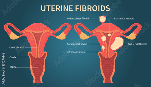 Flat vector illustration of uterine fibroids, myoma, uterine leiomyomas on dark blue background. There are cervical canal, cervix, vagina, pedunculated, intracavitary, submucosal, subserosal fibroid.