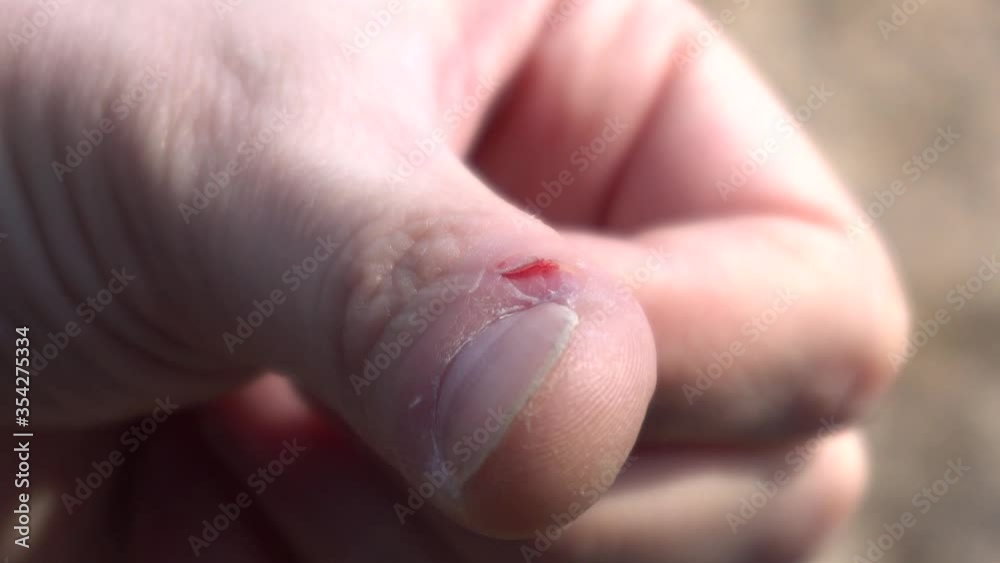A gnawed fingernail, a torn burr, and cracked skin on the arm. Problem manicure, close-up A gnawed fingernail, a torn burr, and cracked skin on the arm. Problem manicure, close-up